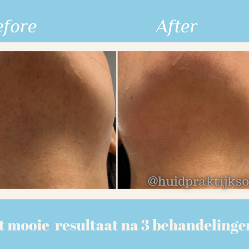 Laserontharing before - after2